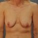 View Breast Augmentation Patient 3319 Before - 1