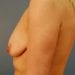 View Breast Augmentation Patient 3319 Before - 2