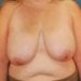 View Breast Reduction Patient 3919 Before - 1