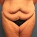 View Abdominoplasty Patient 19 Before - 1