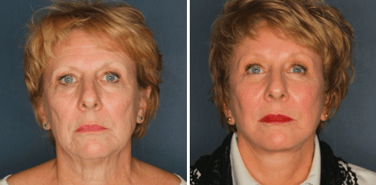 Before And After Patient Photo 