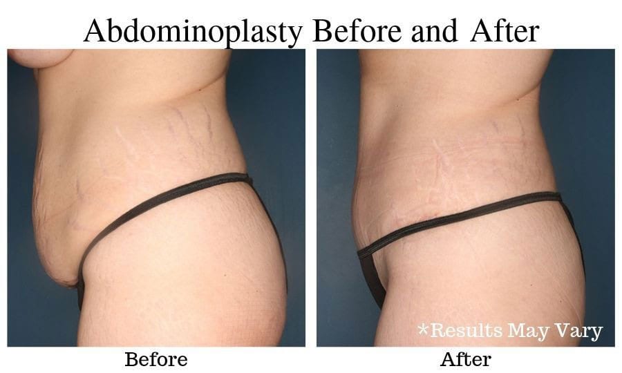 Before and after image showing results of a female patient's tummy tuck surgery in Birmingham, Al.