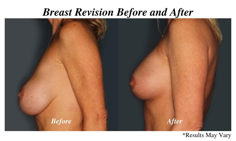 3 Reasons to Replace Your Damaged Breast Implants