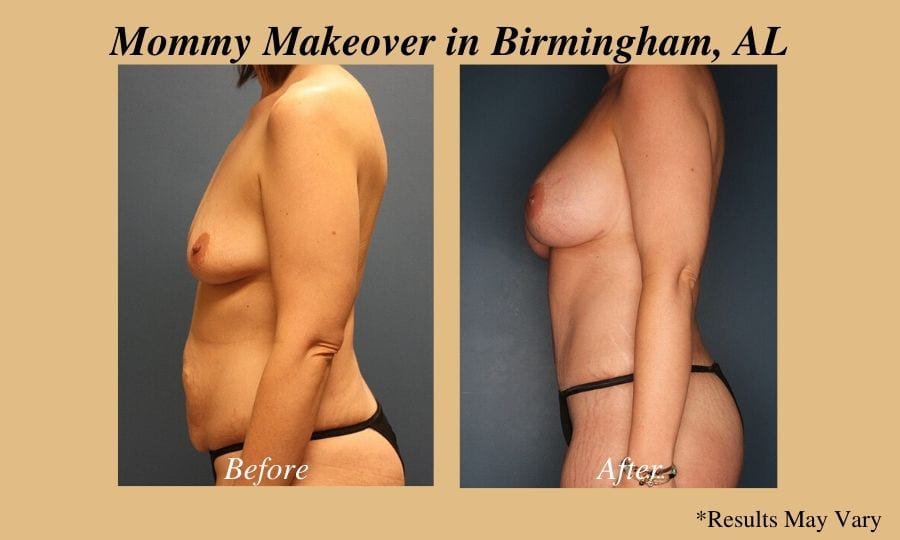 Before and after of Mommy Makeover patient in Birmingham, AL