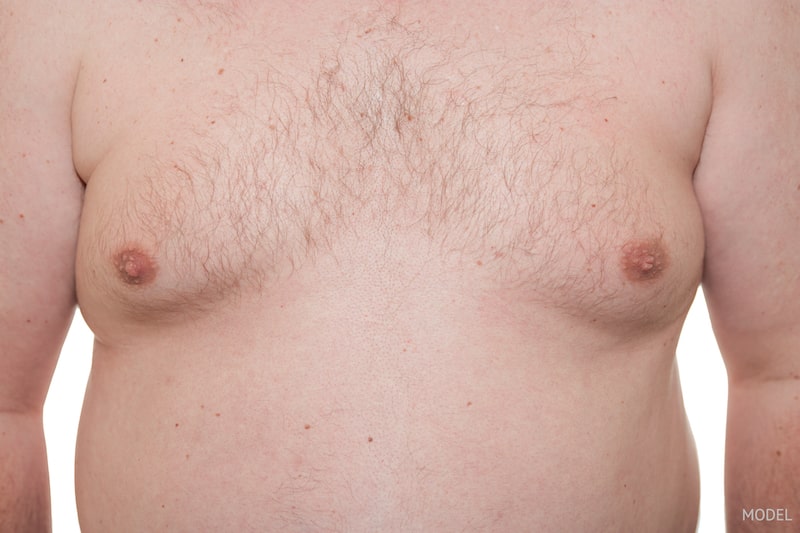 Close-up image of man's chest showing his gynecomastia.