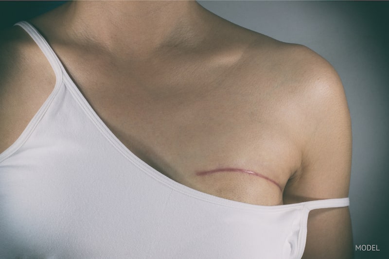 Woman with a surgical scar just above breast showing a mastectomy.