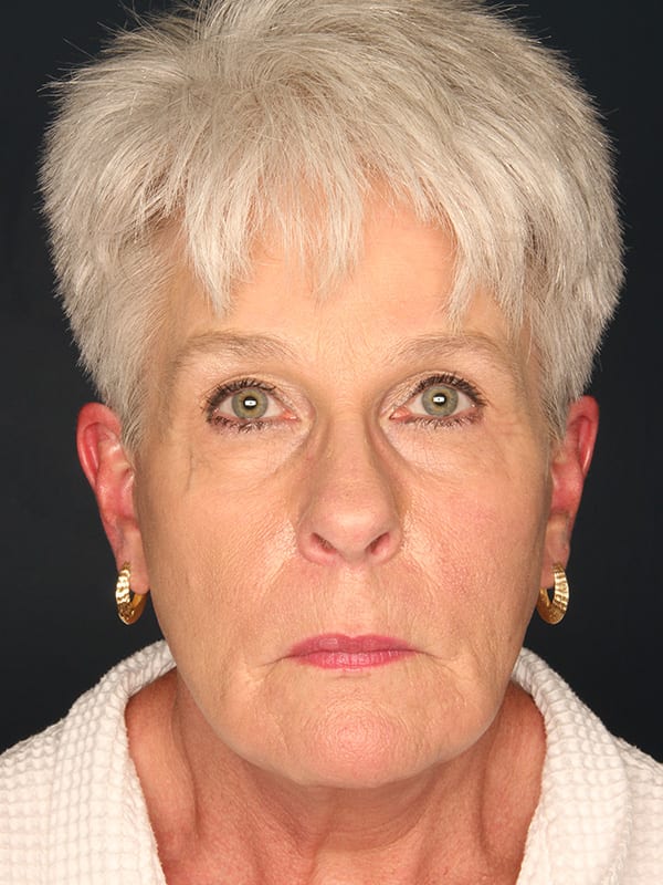 Facelift-Patient-01 | After Facelift