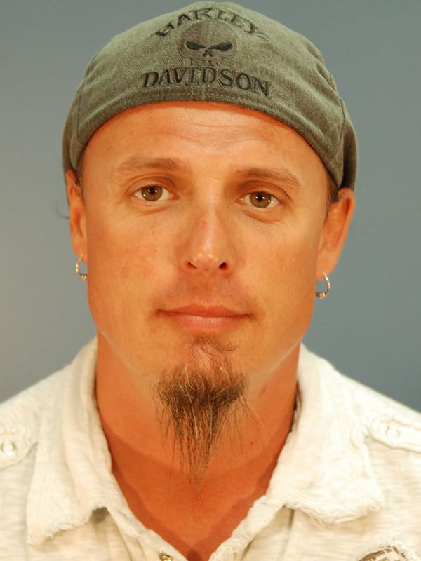 Rhinoplasty-Patient-01 | After Rhinoplasty