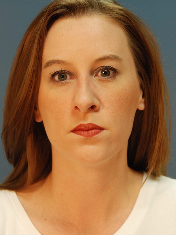 Rhinoplasty-Patient-02 | After Rhinoplasty