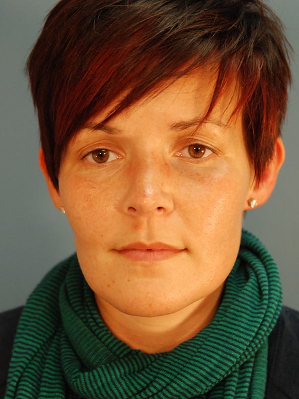 Rhinoplasty-Patient-0129 | After Rhinoplasty