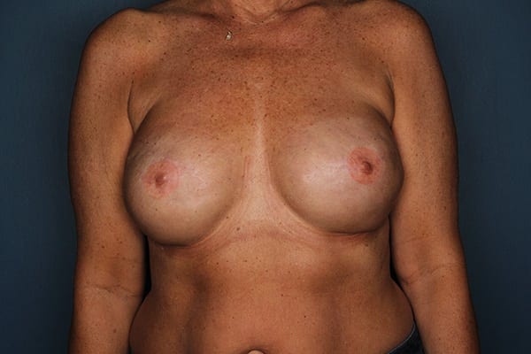 After Implant-Based Non-Nipple Sparing Reconstruction