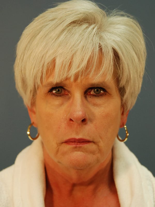 Facelift-Patient-01 | Before Facelift