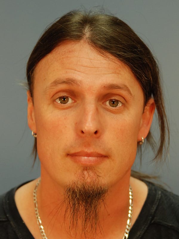 Rhinoplasty-Patient-01 | Before Rhinoplasty