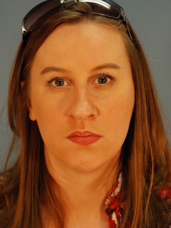 Rhinoplasty-Patient-02 | Before Rhinoplasty