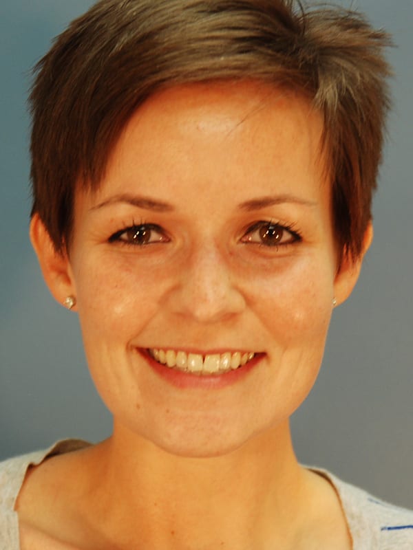 Rhinoplasty-Patient-0129 | Before Rhinoplasty