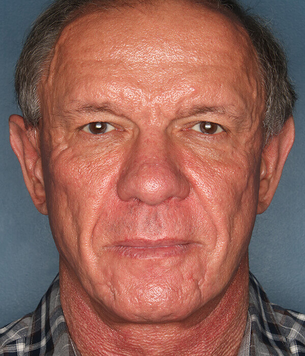 Patient-2921 | After Facelift