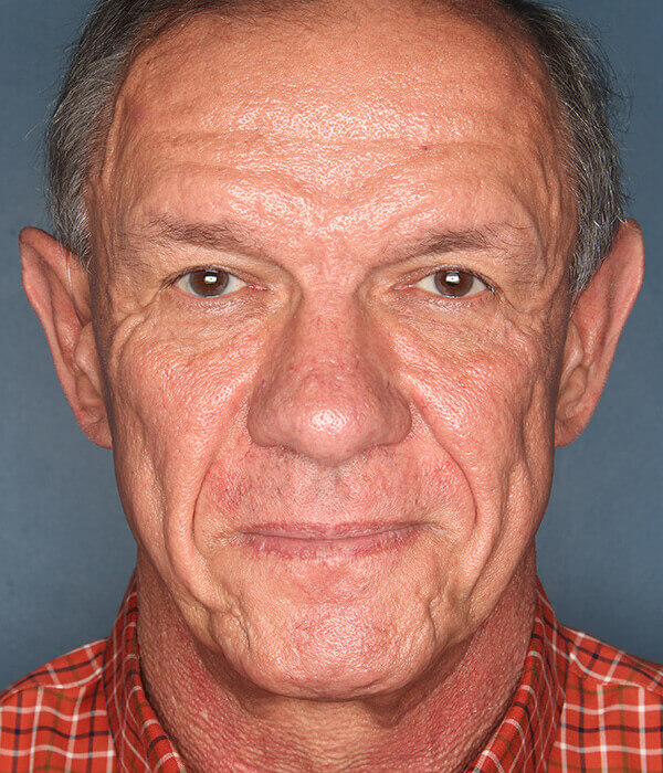 Patient-2921 | Before Facelift