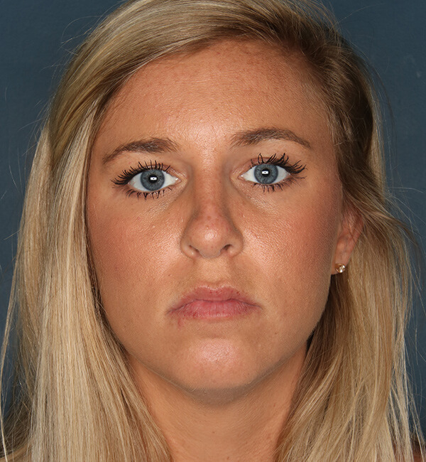 Patient-3321 | After Rhinoplasty