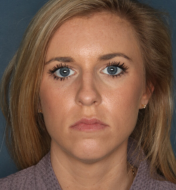 Patient-3321 | Before Rhinoplasty