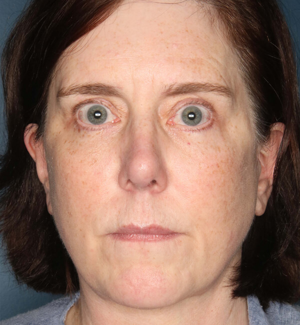 Patient-4621 | After Rhinoplasty