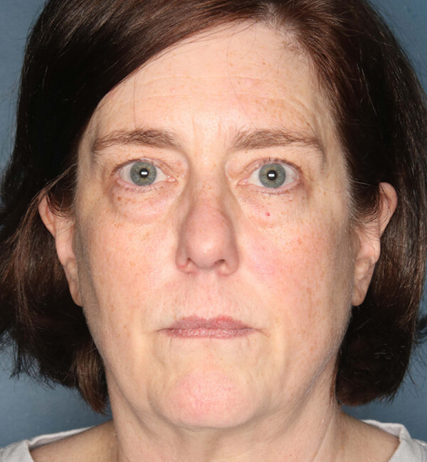 Patient-4621 | Before Rhinoplasty