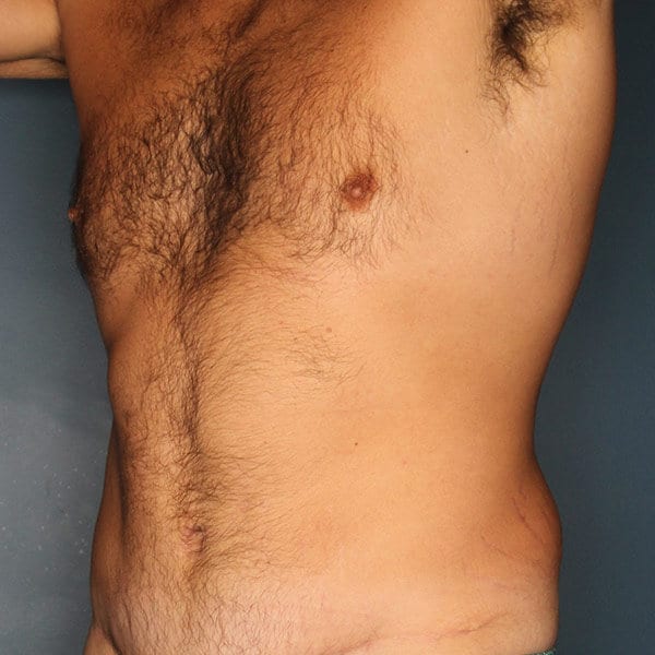 Mens Tummy Tuck Patient After Photo
