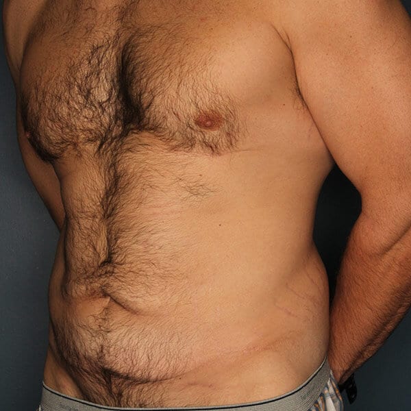 Mens Tummy Tuck Patient Before Photo