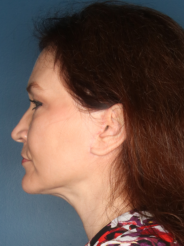 Neck Lift After Patient Photo