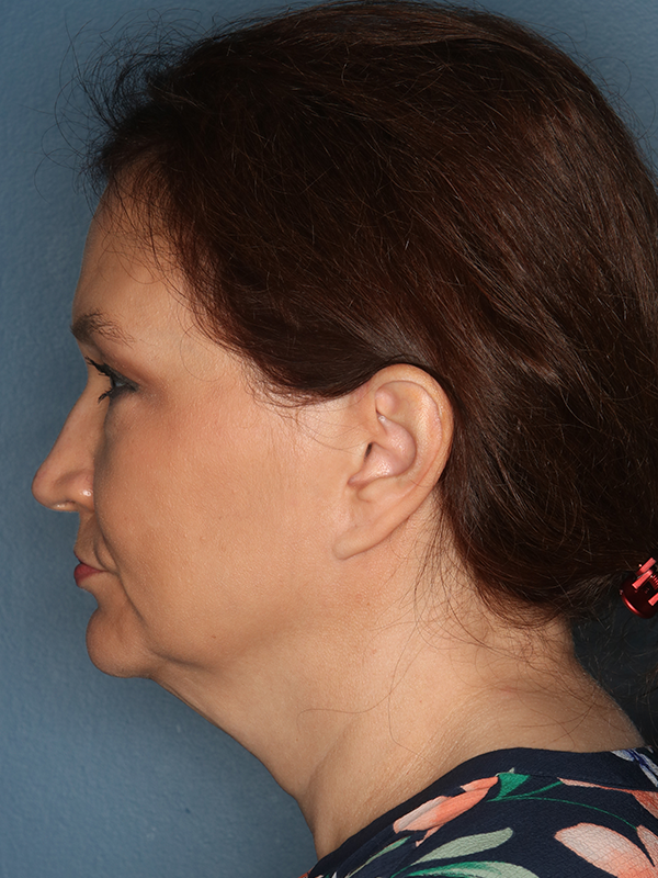 Neck Lift Before Patient Photo