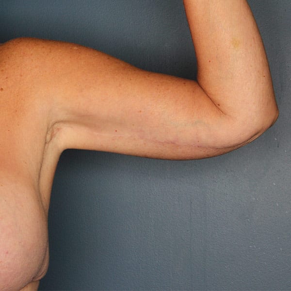 Arm Lift After Patient Photo