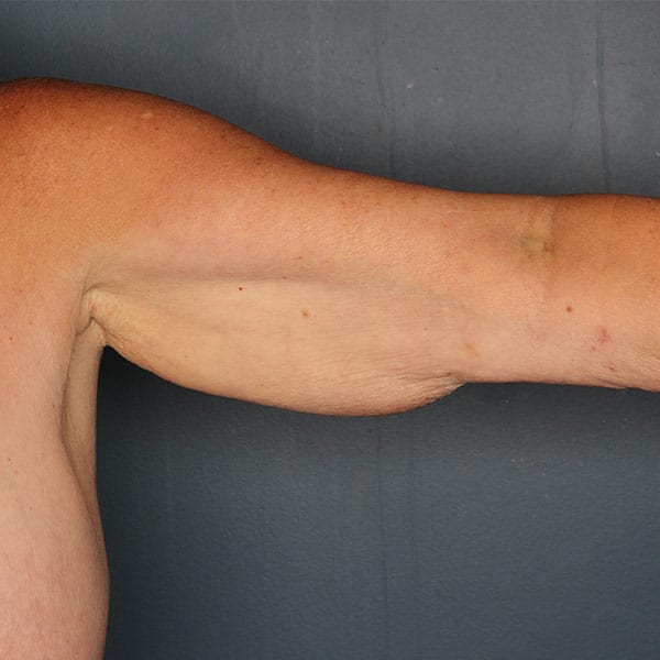 Arm Lift Before Patient Photo