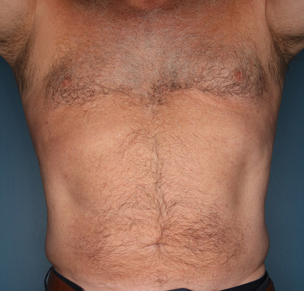 Liposuction for Men After Patient Photo