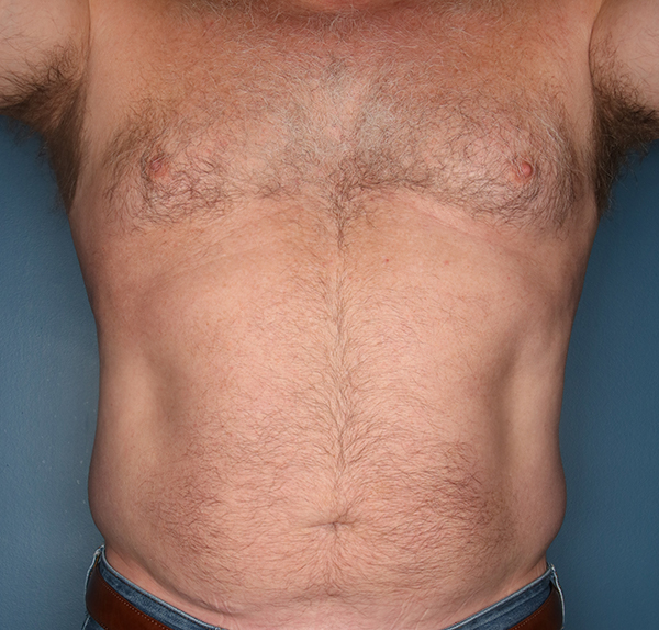 Liposuction for Men Before Patient Photo