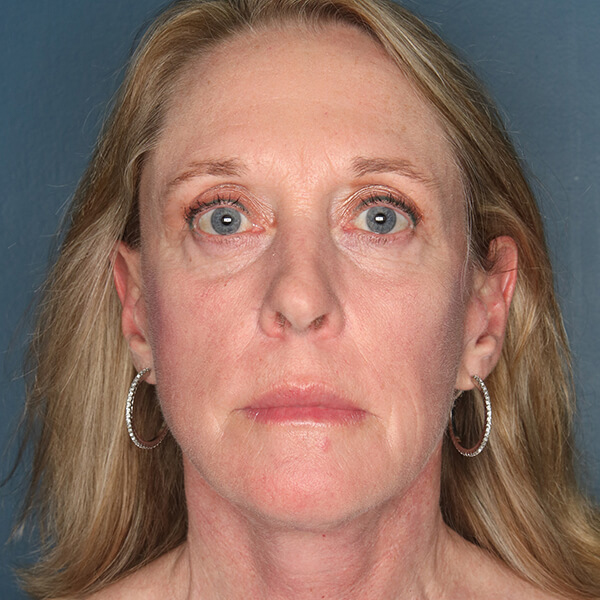 Patient-3120 | After Facelift