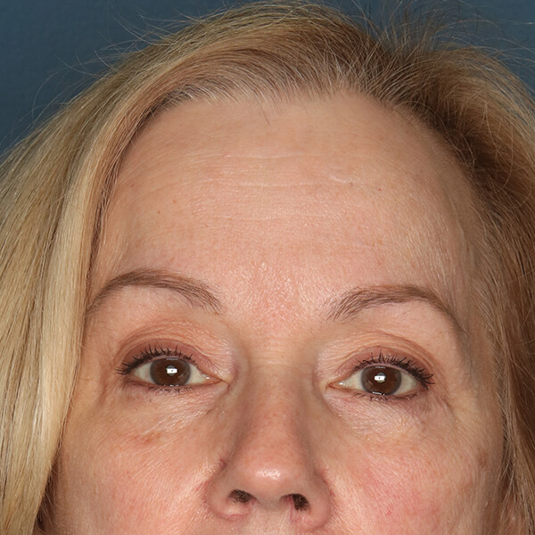 Brow Lift Patient After Photo