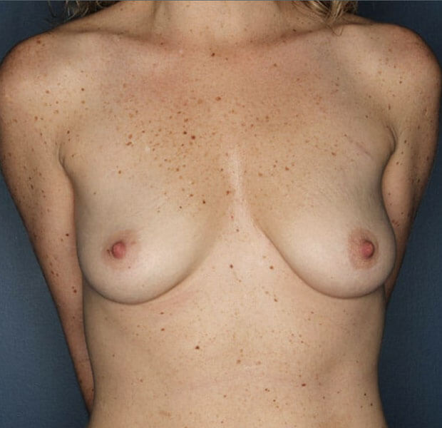 Breast Augmentation Lift Before Patient Photo