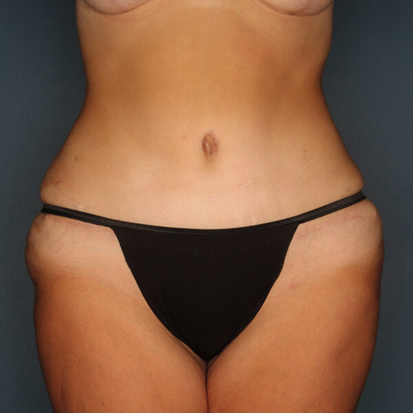 Tummy Tuck After Patient Photo