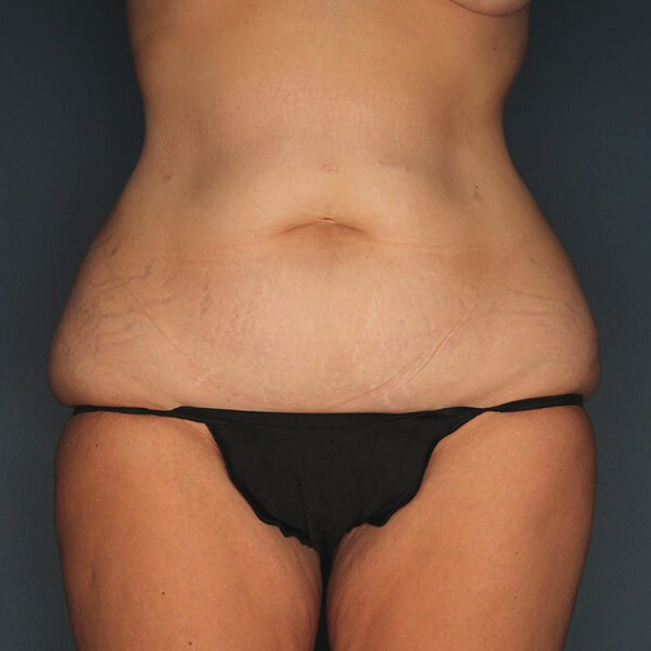 Tummy Tuck Before Patient Photo