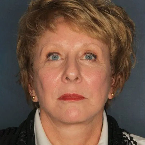 Facelift After Patient Photo