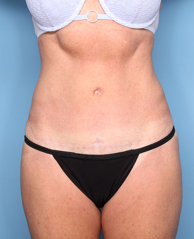 Case--29424 | After Abdominoplasty