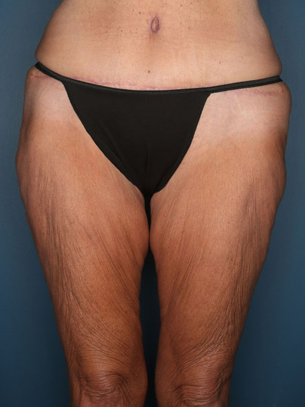 Case--39724 | Before Thigh Lift