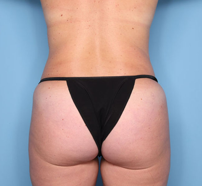 Case--36424 | After Body