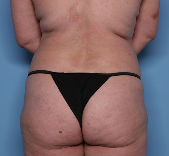 Case--36524 | Before Body