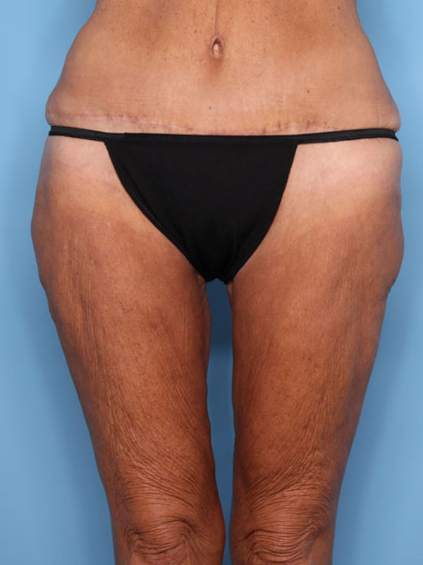 Case--39724 | After Thigh Lift