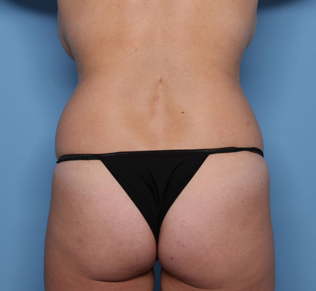 Case--36624 | Before Liposuction