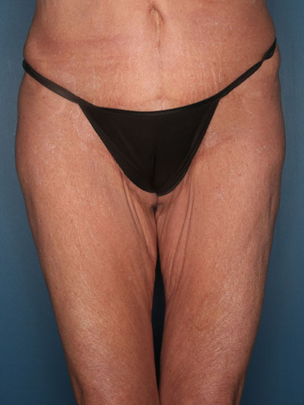 Case--39824 | Before Thigh Lift