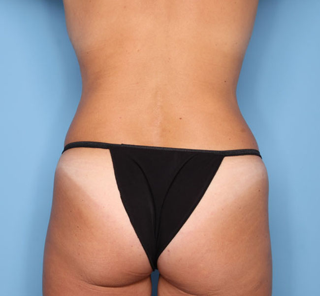 Case--36624 | After Liposuction