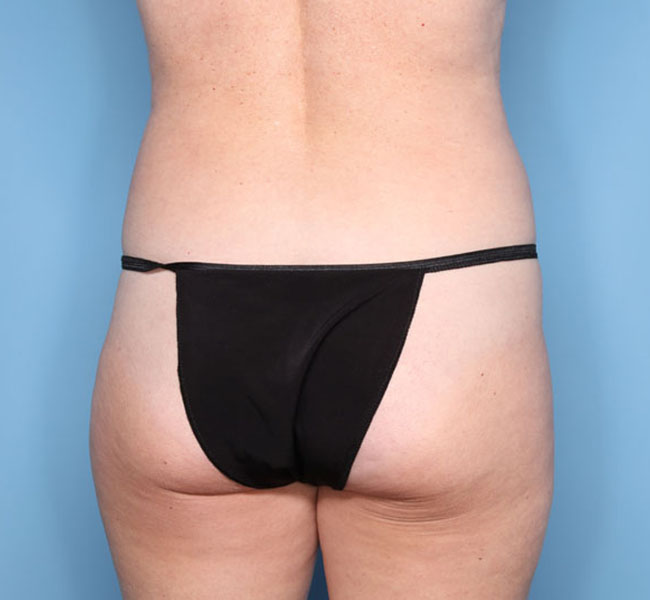 Case--36724 | Before Liposuction