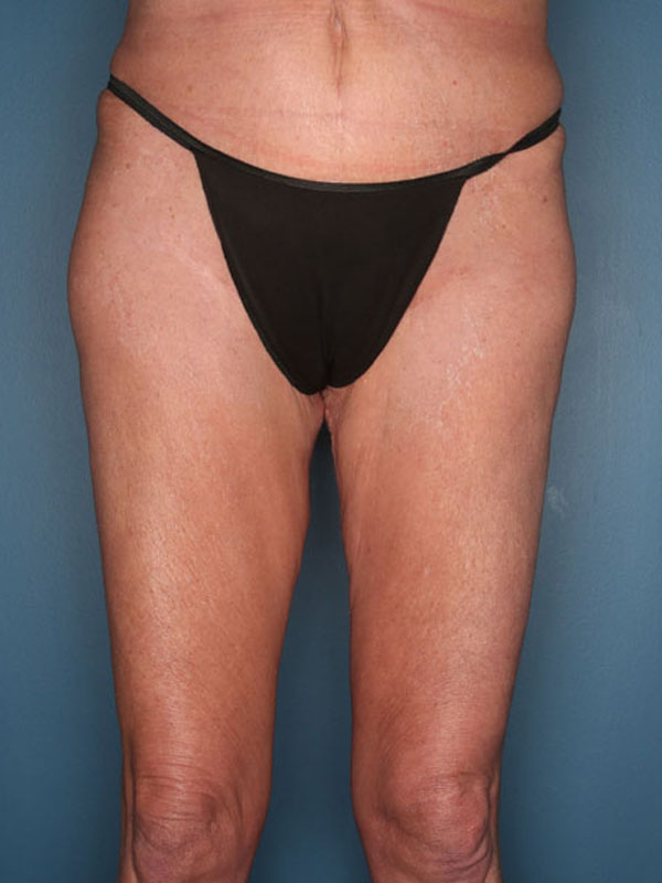 Case--39824 | After Thigh Lift