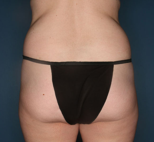 Case--36824 | Before Liposuction